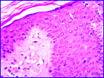 Dermatopathology Slide: H&E Stain