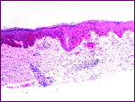 Dermatopathology Slide: HMB-45 Stain