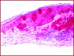 Dermatopathology Slide: S-100 Stain